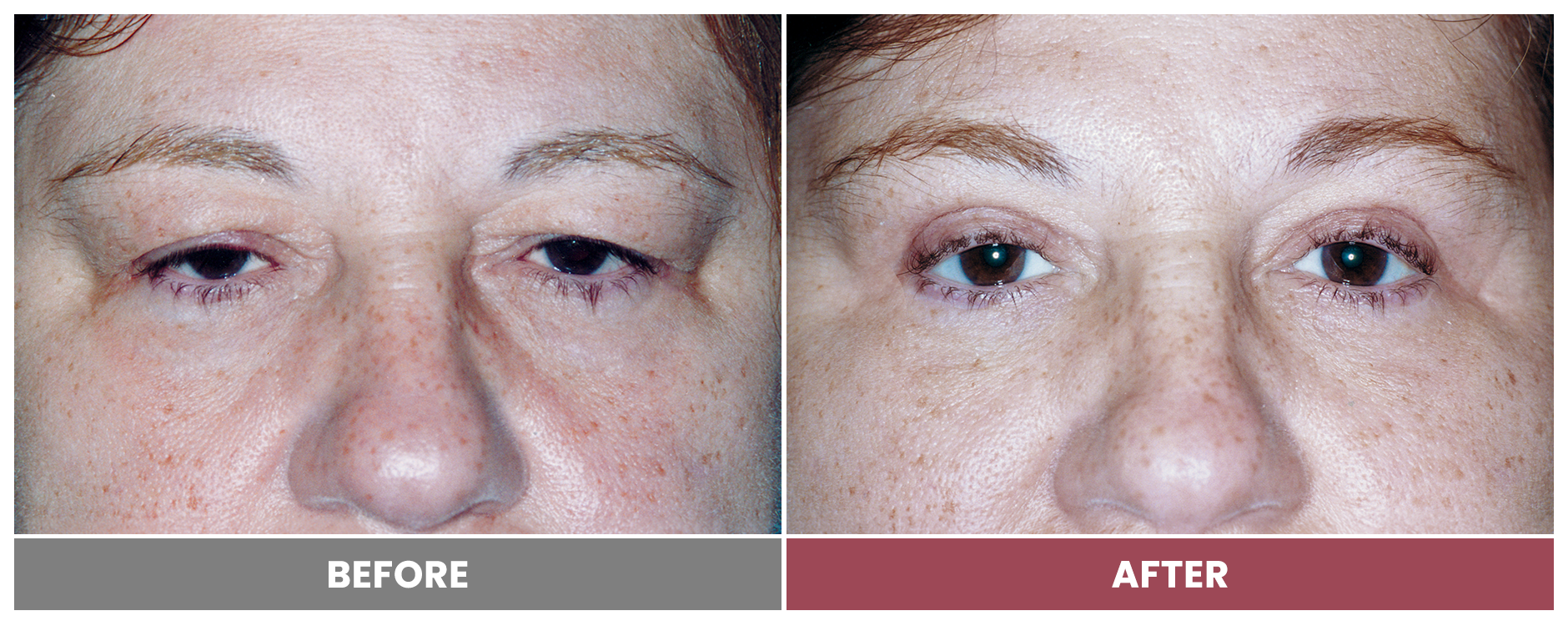 Upper Blepharoplasty - Case 14